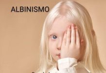 ALBINISMO